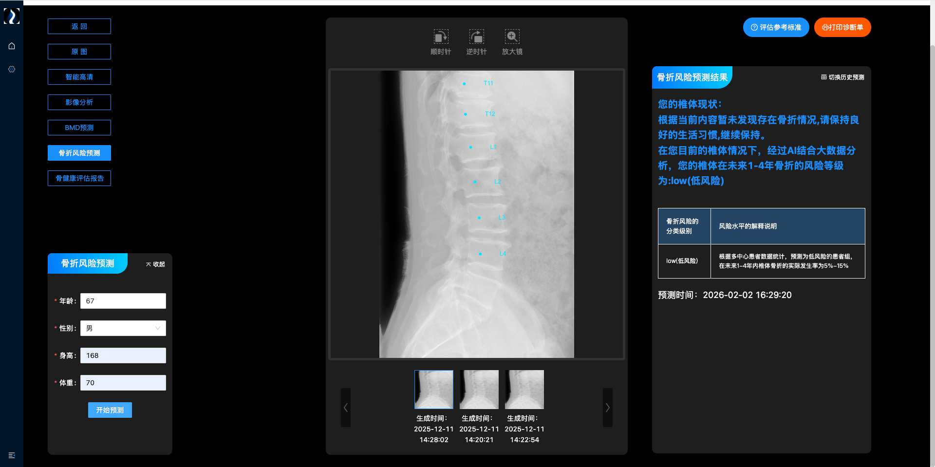 骨质疏松性椎体骨折预测系统