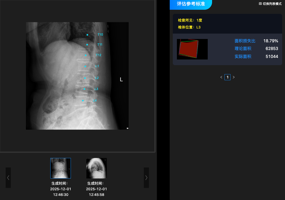 骨质疏松性椎体骨折辅助诊断系统(基于CT)